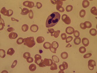 anemia