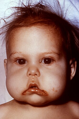 malnutrition