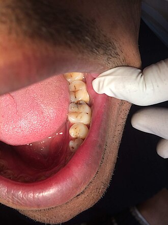 dental decay