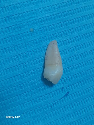 premolar