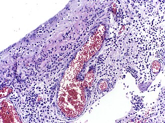 Inflammation