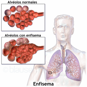 Emphysema