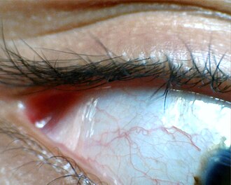 Conjunctiva