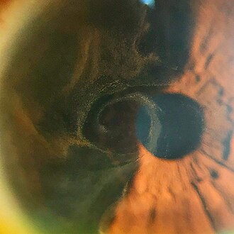 Cornea