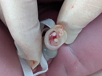 Umbilical cord