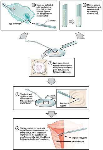 In vitro fertilization