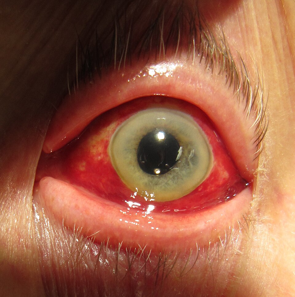 Red-eye